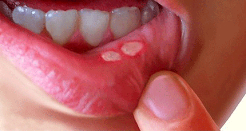 تعريف مرض بهجت وماهي علامات ظهوره