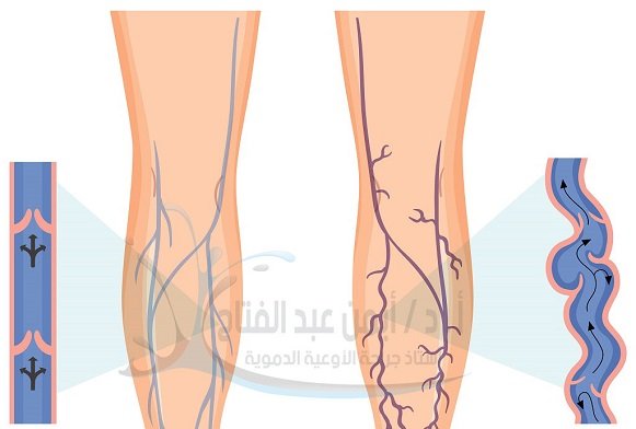 بتر القدم