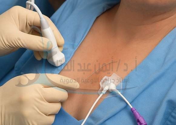 قساطر العلاج الكيميائي